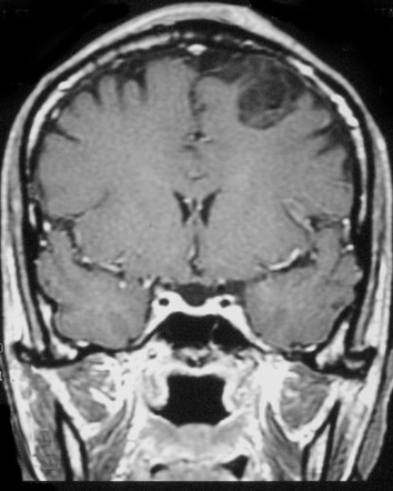 Dysembryoplastic neuroepithelial tumor (DNET) | Image | Radiopaedia.org