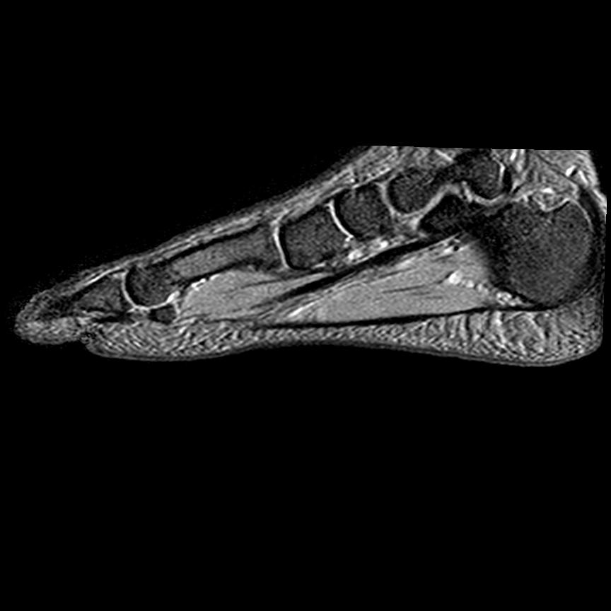 Sesamoiditis | Image | Radiopaedia.org