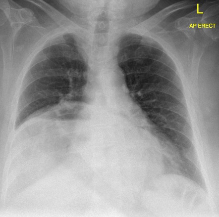 Intrathoracic stomach | Radiology Case | Radiopaedia.org