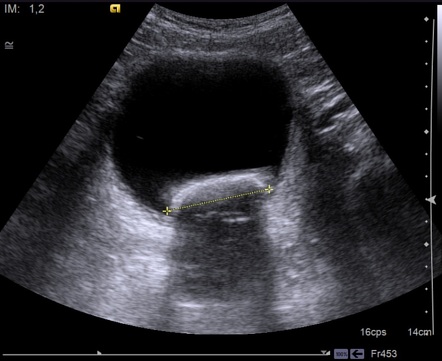 Bladder calculus | Radiology Case | Radiopaedia.org