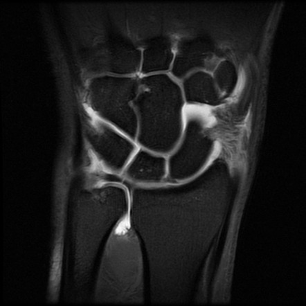 TFCC tear Palmer 1a | Radiology Case | Radiopaedia.org