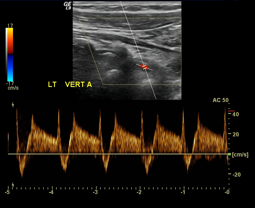 Subclavian Steal Syndrome Image