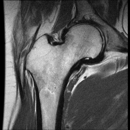 Negative intra-articular contrast | Image | Radiopaedia.org