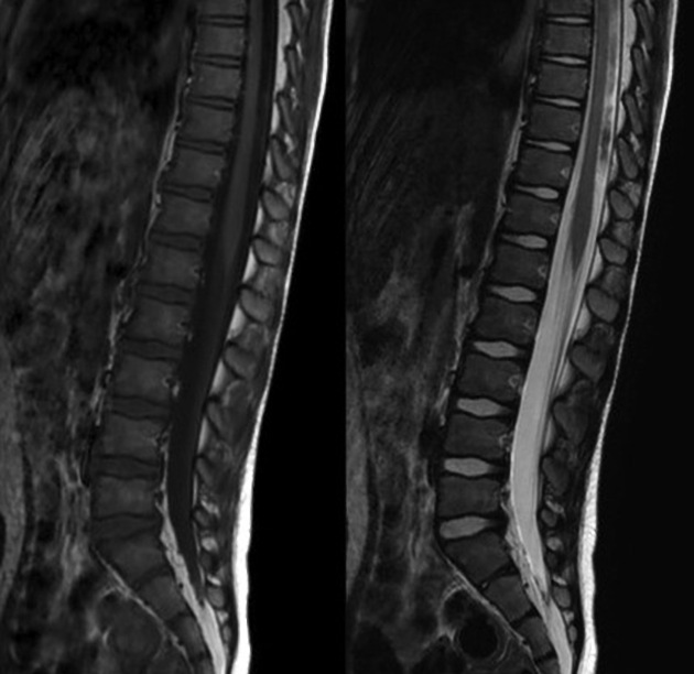 Guillain Barre Syndrome Radiology Case Radiopaedia Org