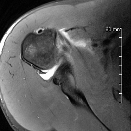 Humeral avulsion of inferior glenohumeral ligament (HAGL) following ...