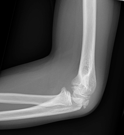 Capitellum fracture | Radiology Reference Article | Radiopaedia.org