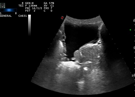 Multiple bladder diverticula | Image | Radiopaedia.org