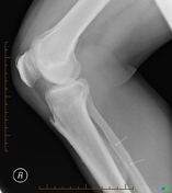 Periosteal reaction | Radiology Reference Article | Radiopaedia.org