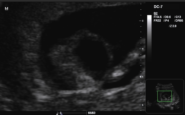 Fetal Megacystis Radiology Case Radiopaedia Org