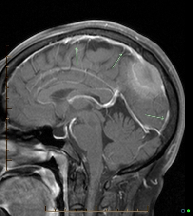 Meningioma invading superior sagittal sinus | Image | Radiopaedia.org