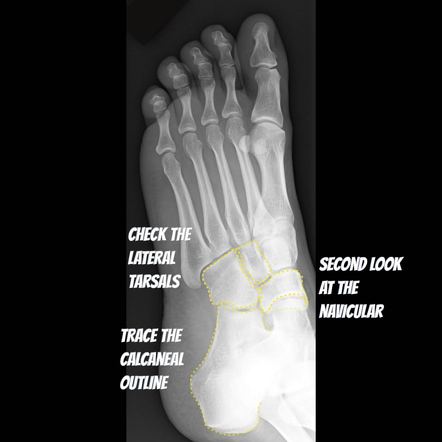 Foot radiograph (an approach) | Radiology Reference Article ...