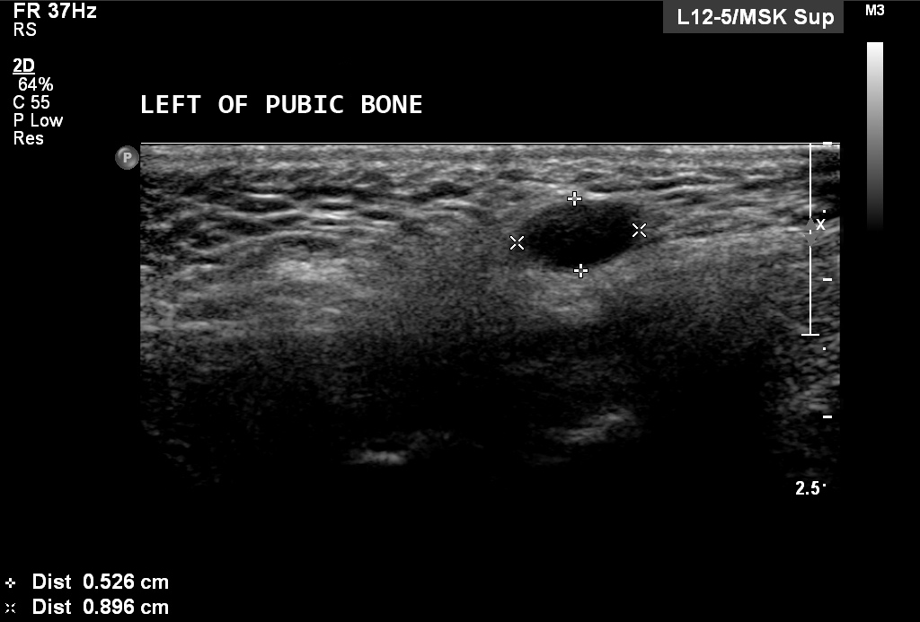 Hydrocele Of Canal Of Nuck Image