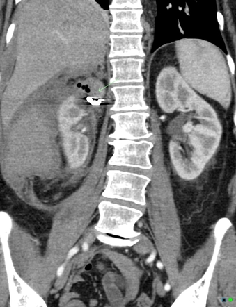 Post embolization syndrome | Radiology Case | Radiopaedia.org