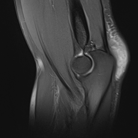 right elbow olecranon bursitis icd 10