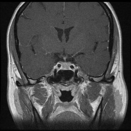 Post partum enlargement of pituitary | Image | Radiopaedia.org