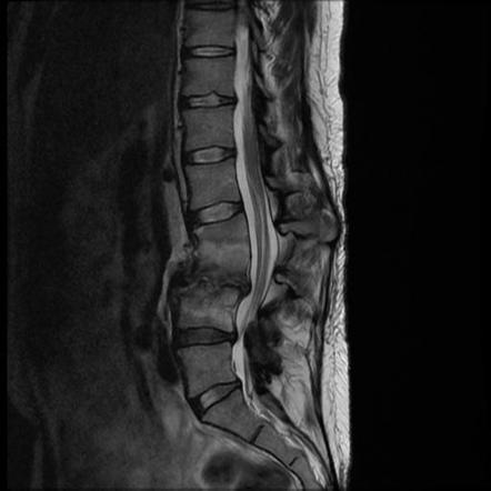 Discitis Osteomyelitis | Radiology Case | Radiopaedia.org