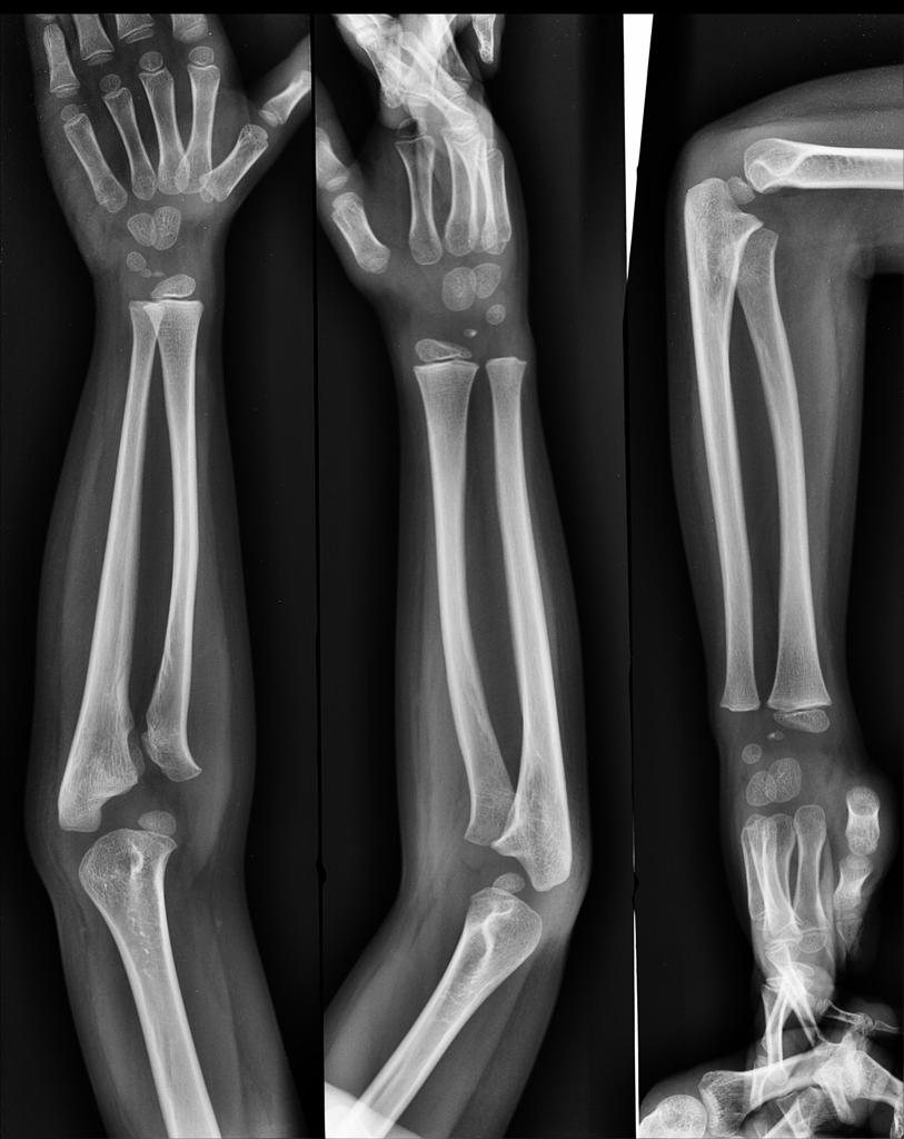 proximal radioulnar joint