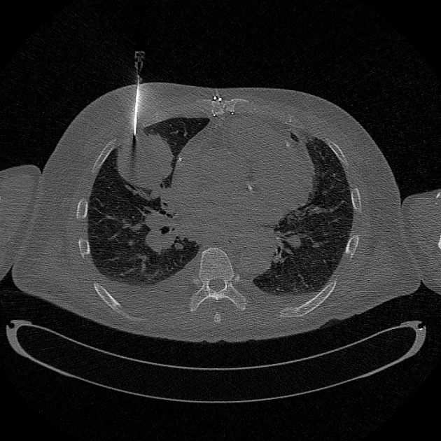 Ct Guided Lung Biopsy Step By Step Guide Radiology Case Radiopaedia Org