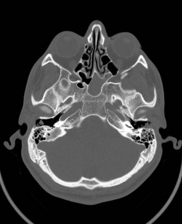 Left mastoid fracture | Radiology Case | Radiopaedia.org