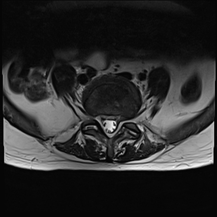 Spondylodiscitis | Image | Radiopaedia.org