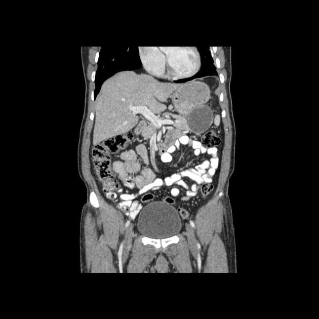 Pseudocyst Of Pancreas Radiology Case Radiopaedia Org