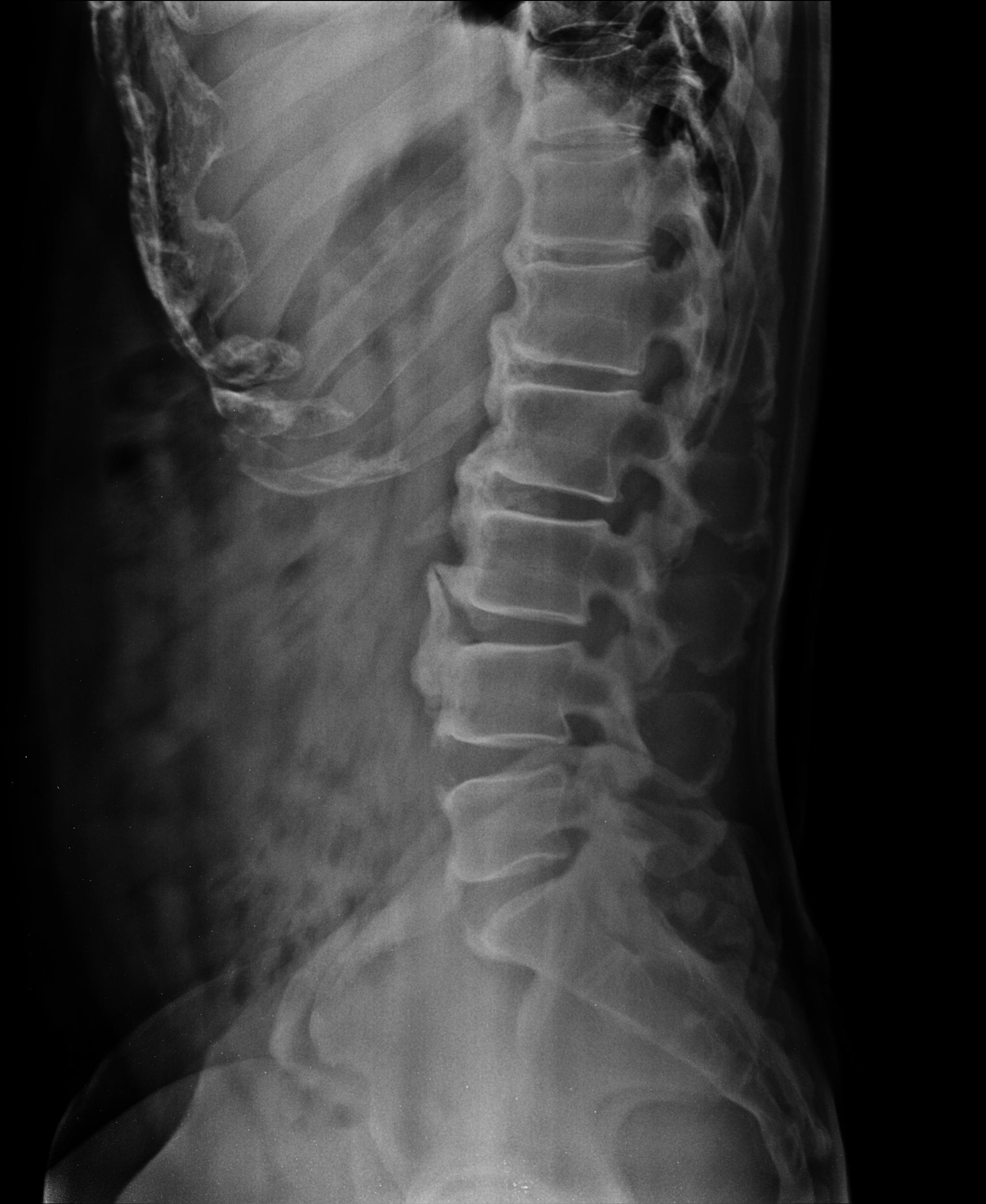 Diffuse idiopathic skeletal hyperostosis (DISH) | Image | Radiopaedia.org