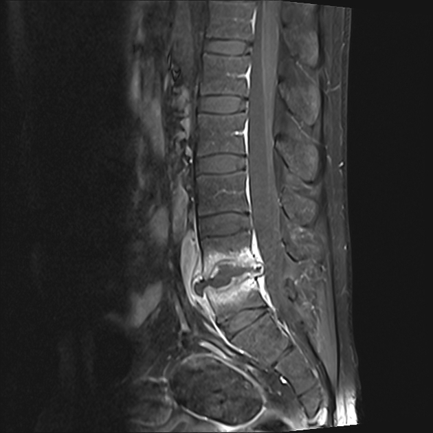 Spondylodiscitis | Radiology Reference Article | Radiopaedia.org