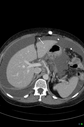 Ligamentum teres (abdomen) | Radiology Reference Article | Radiopaedia.org