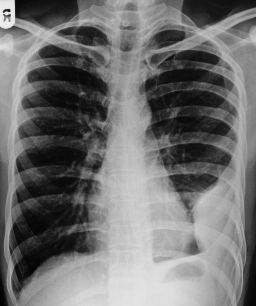 Loculated Pleural Effusion Radiology Case Radiopaedia Org