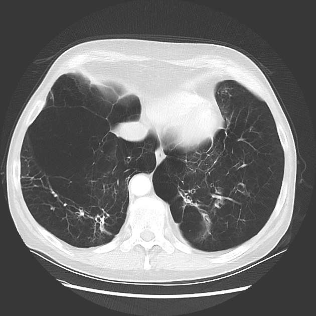 Alpha-1-antitrypsin deficiency | Radiology Reference Article ...