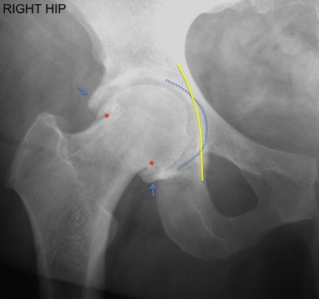 Pincer type femoroacetabular impingement | Image | Radiopaedia.org