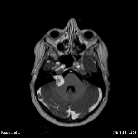 Cerebellopontine angle mass (mnemonic) | Radiology Reference Article ...