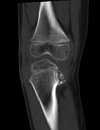 Blount disease | Image | Radiopaedia.org