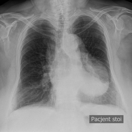 Thoracic Aortic Aneurysm Radiology Case Radiopaedia Org