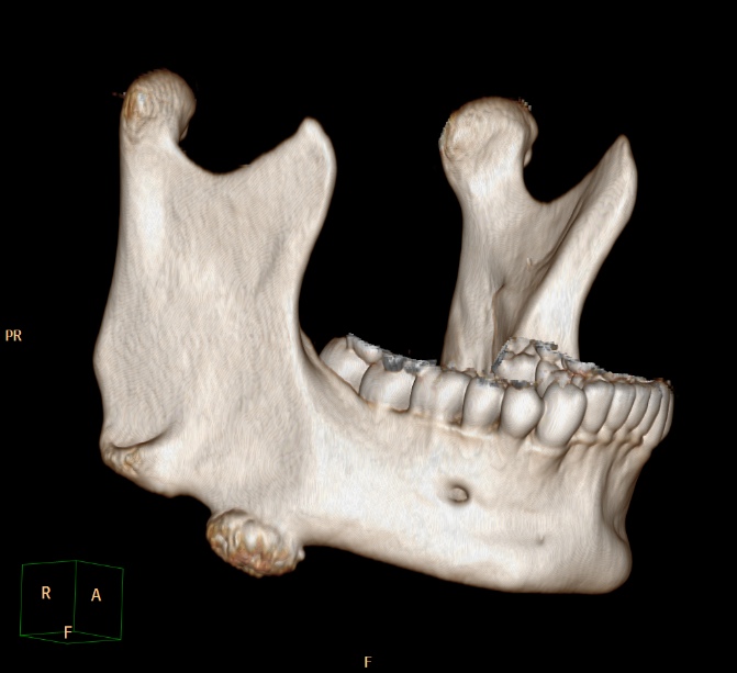 Osteoid Osteoma Jaw