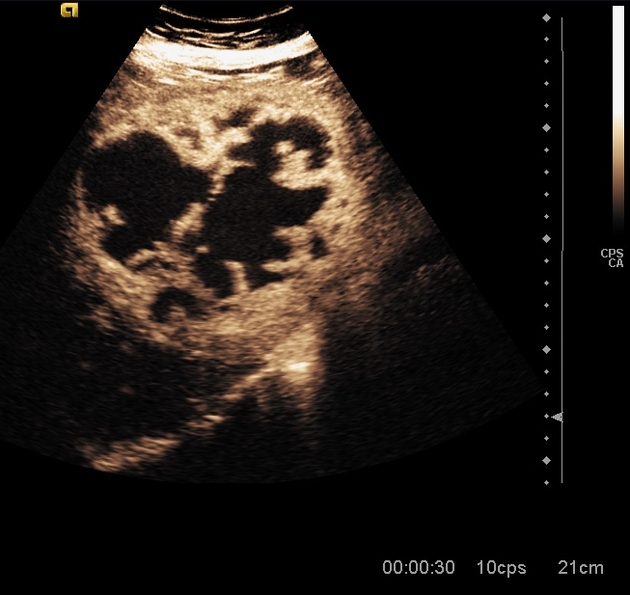 Hepatic Abscess Radiology Reference Article