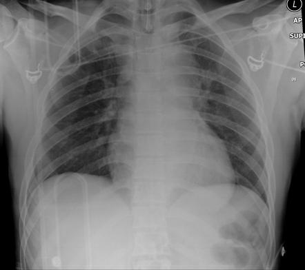 Traumatic aortic transection | Radiology Case | Radiopaedia.org