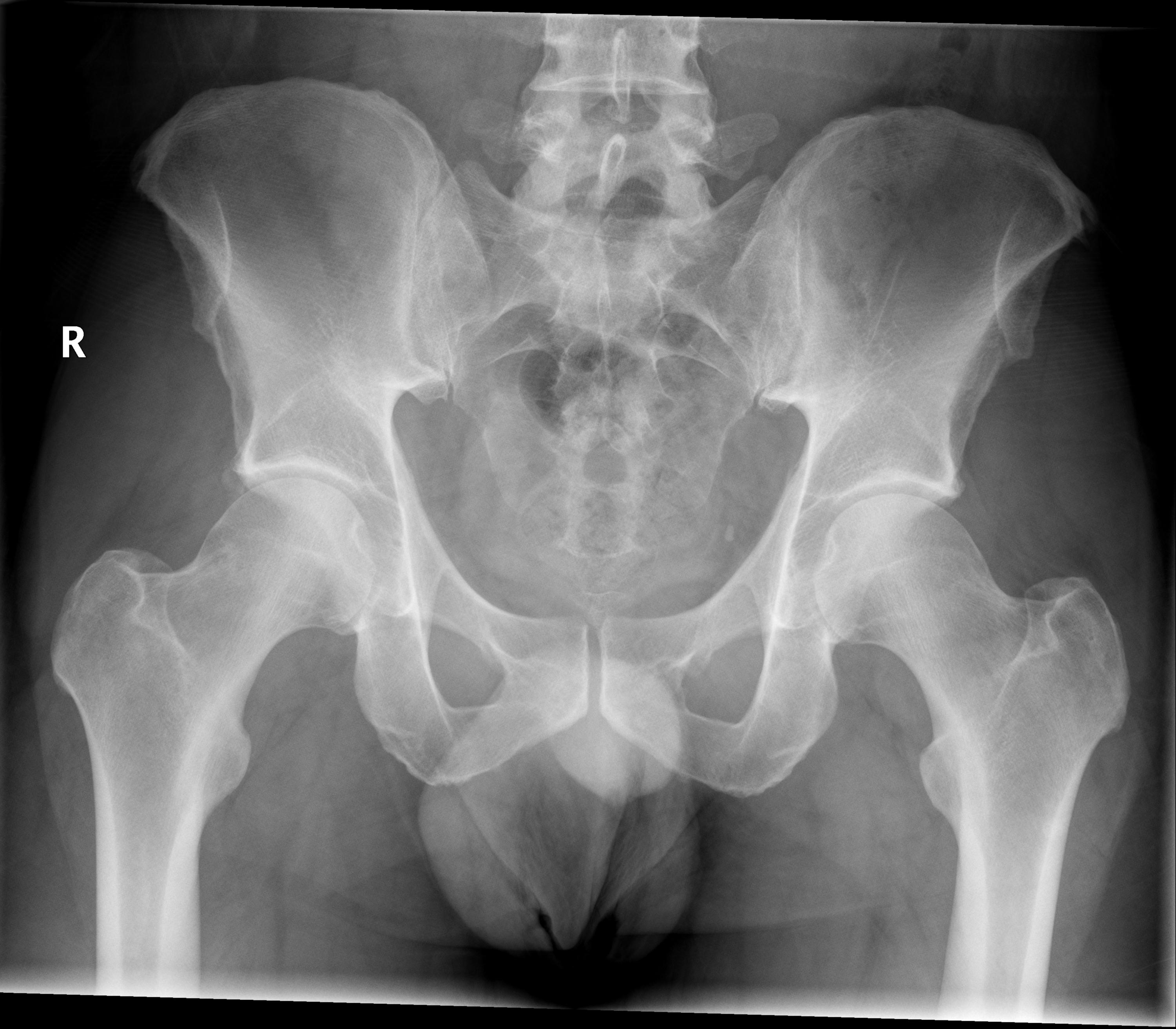 Bilateral Femoro Acetabular Impingement Image 8542