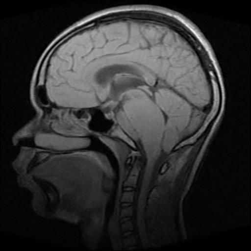 Brainstem Glioma 