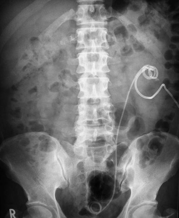 Ureteric stent | Radiology Reference Article | Radiopaedia.org