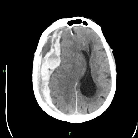 Viewing playlist: Subdural hemorrhage | Radiopaedia.org