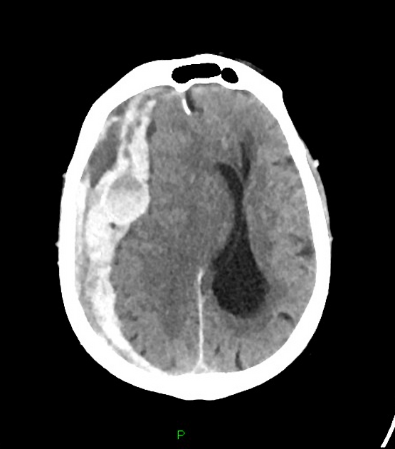 acute subdural hematoma mri