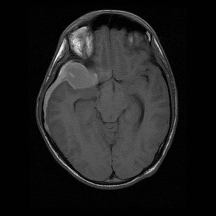 Right temporal arachnoid cyst with intracystic and subacute subdural ...