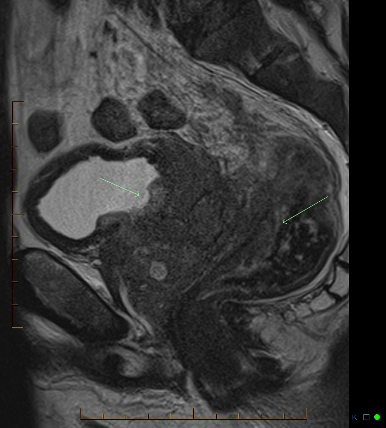 locally-advanced-prostate-cancer-image-radiopaedia