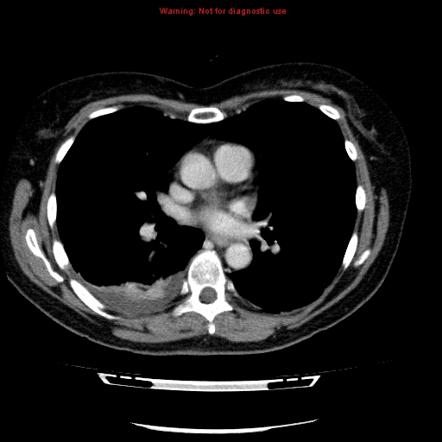 Acute Gangrenous Cholecystitis | Image | Radiopaedia.org