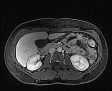 Focal nodular hyperplasia on Primovist MR and 4-phase CT | Image ...