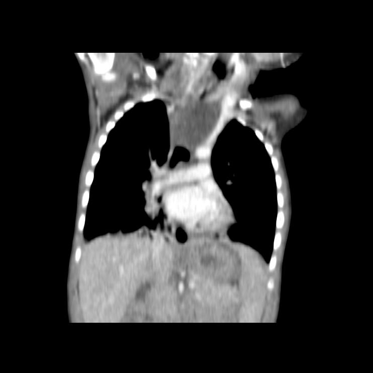 Esophageal Duplication Cyst Image