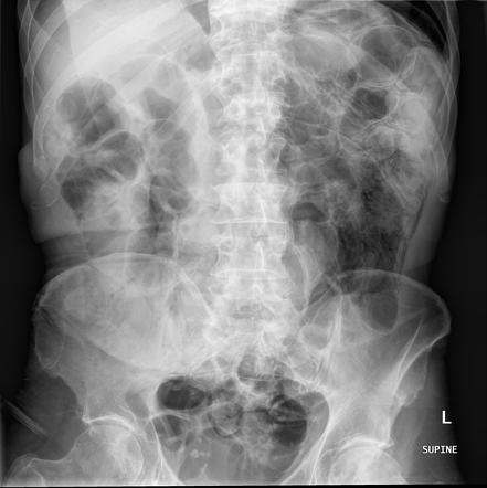 Pneumoperitoneum (summary) | Radiology Reference Article | Radiopaedia.org