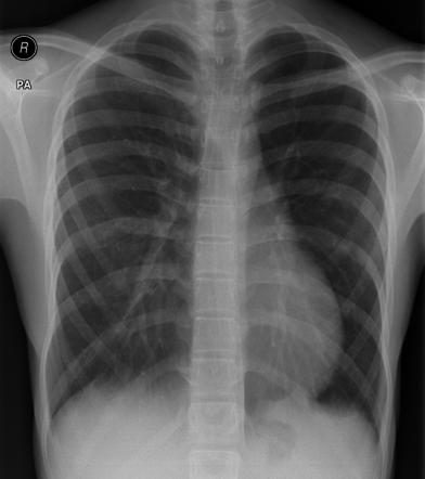 Pectus Excavatum Radiology Case Radiopaedia Org