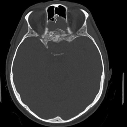 Olfactory groove meningioma - huge | Image | Radiopaedia.org